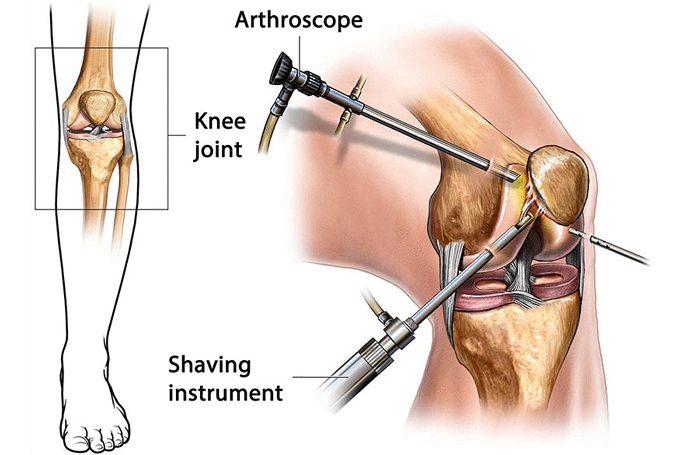 Arthroscopy and Knee joint images
