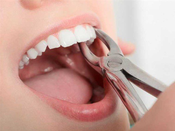 Affordable Tooth Extraction Images