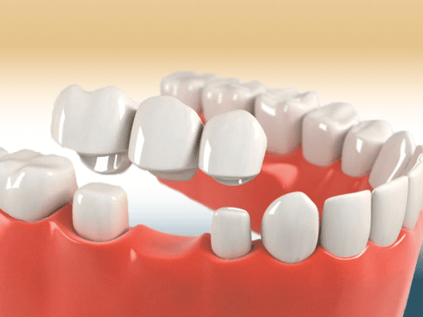 Affordable Dental Crown and Brace Images