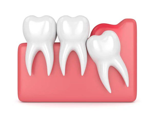 Affordable Tooth Impaction Images