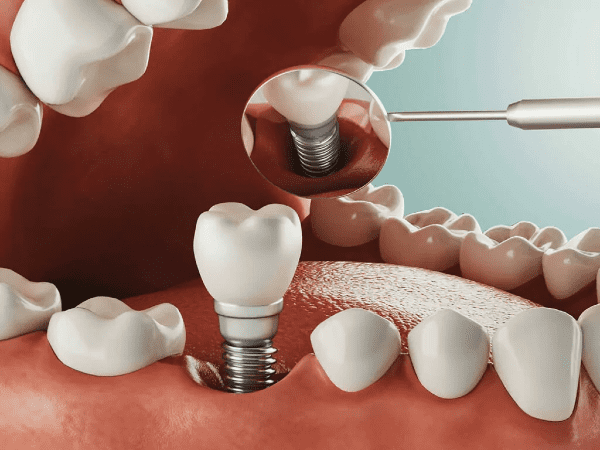 Affordable Dental Implant Images