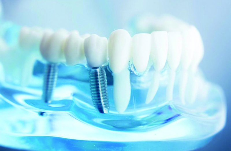 Dental Implant Images