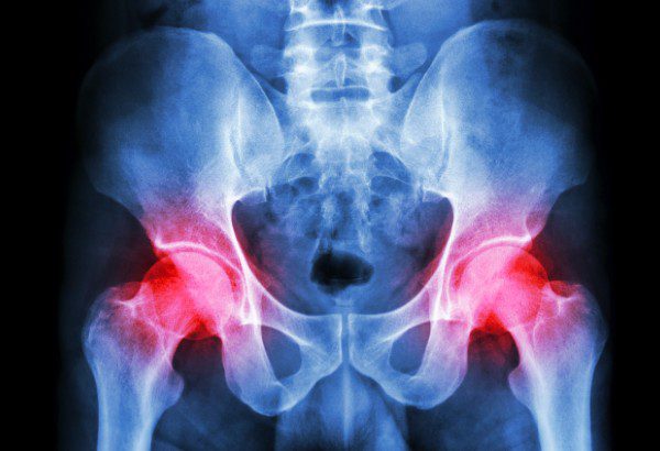 hip replace and pain images