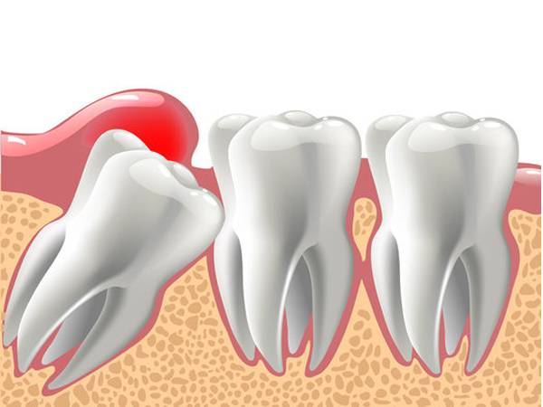 Affordable Tooth Impaction Images