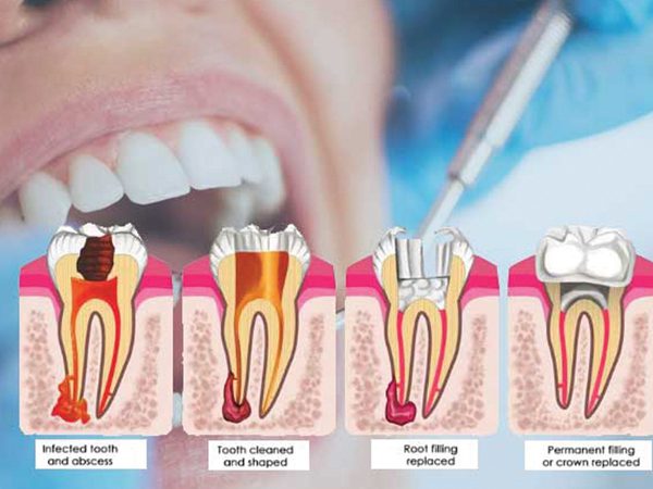 Affordable Root Canal Images