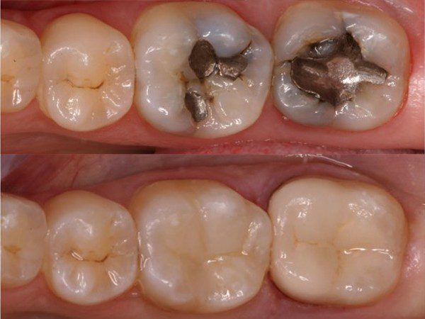 Dental Tooth Filling image