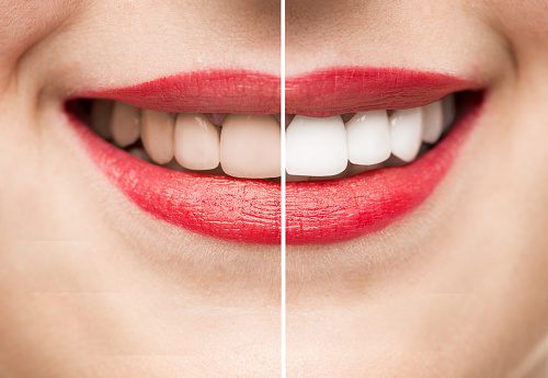Teeth After and Before Whitening high quality images