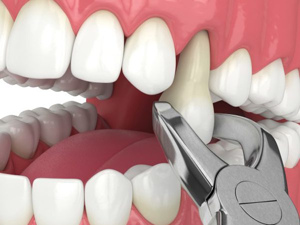 Affordable Tooth Extraction Images