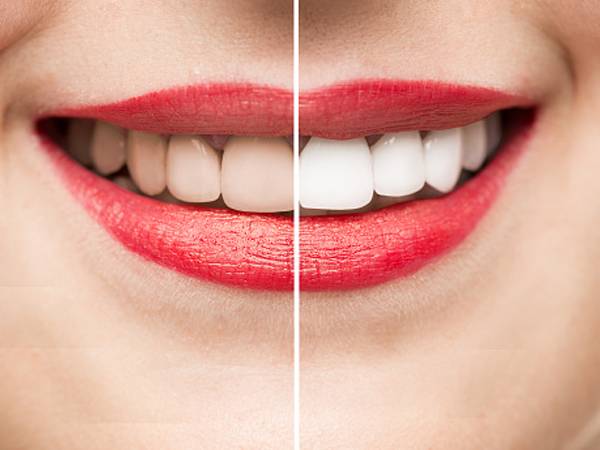 Teeth After and Before Whitening high quality studio shot